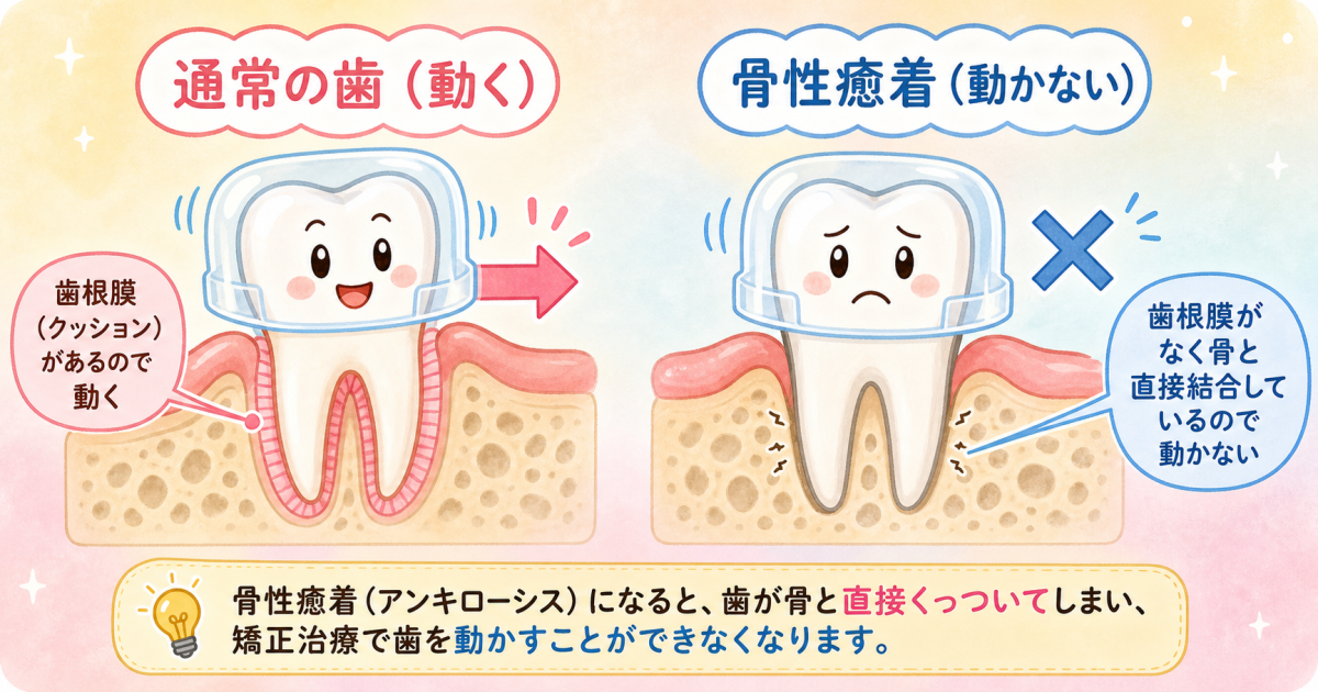 ■骨性癒着(アンキローシス)とは?歯が動かない原因とメカニズム